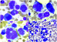 “Multiple forms” of a myeloma