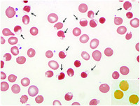 Rasburicase-induced Heinz body hemolytic anemia in a patient with ...