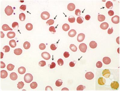 Rasburicase-induced Heinz body hemolytic anemia in a patient with chronic lymphocytic leukemia