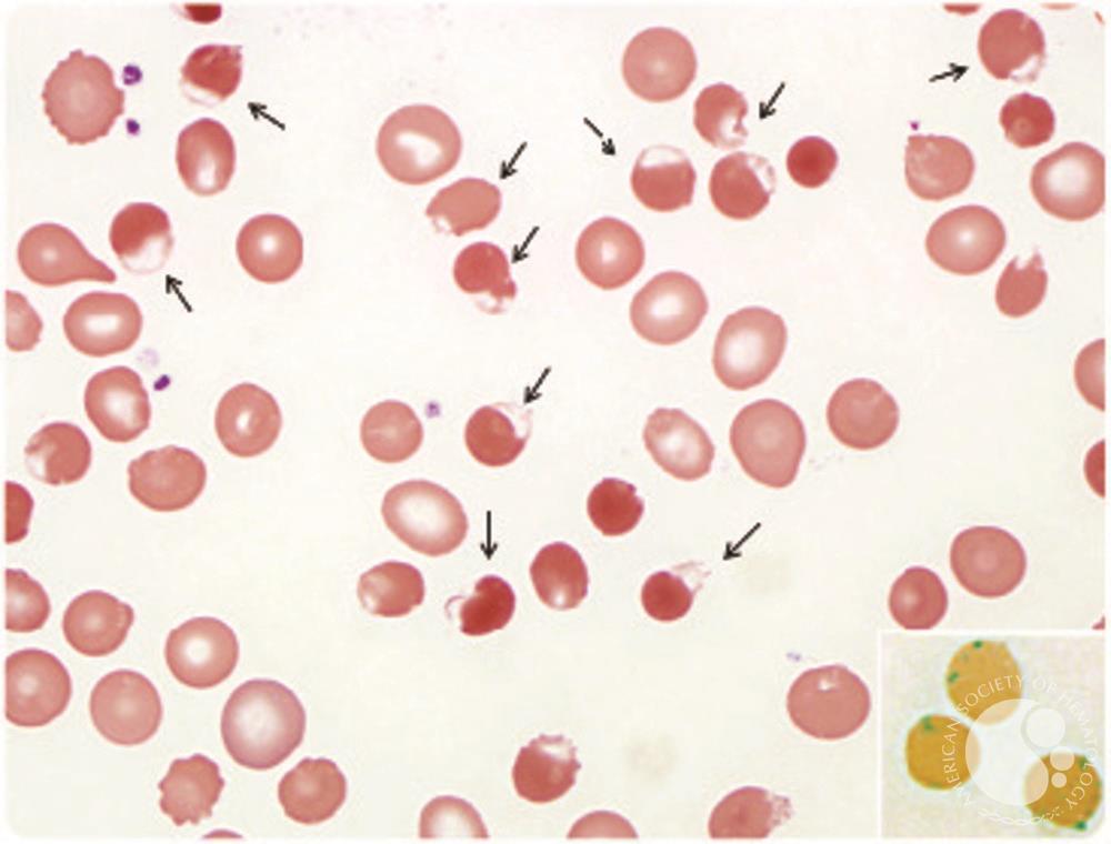 Rasburicase-induced Heinz body hemolytic anemia in a patient with chronic lymphocytic leukemia