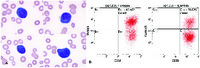 Circulating reactive plasma cells in the setting of peripheral T-cell lymphoma mimicking plasma cell leukemia