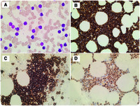 Plasma cell myeloma with lymphoplasmacytic morphology and cyclin D1 expression