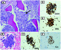 Metastatic epithelioid angiosarcoma with bone marrow involvement