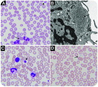 Delayed diagnosis of MYH-9–related disorder and the role of light microscopy in congenital macrothrombocytopenias