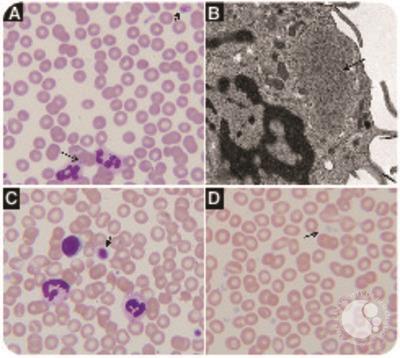 Delayed diagnosis of MYH-9–related disorder and the role of light microscopy in congenital macrothrombocytopenias