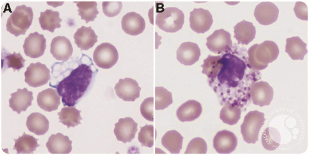 Peripheral blood findings in GM1 gangliosidosis