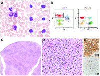 Lymphocytic variant of hypereosinophilic syndrome mimicking peripheral T-cell lymphoma in a young woman