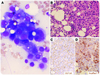 A case of multiple myeloma mimics: extensive bone metastasis of hepatocellular carcinoma without liver mass