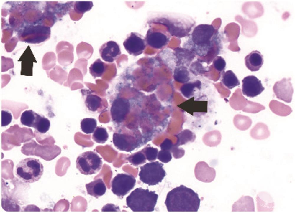 Hemophagocytosis in a patient with sickle cell disease
