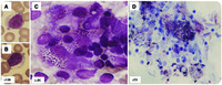 Morphology in mucopolysaccharidosis type III: specific diagnostic features