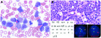 MYC/BCL2 double-hit lymphoma/leukemia mimicking acute leukemia at initial presentation