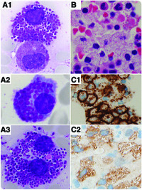 Plasma cell myeloma with numerous cytoplasmic granules