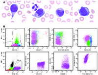 Plasma cell leukemia mimicking acute myeloid leukemia