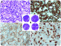 EBV-associated Aggressive Natural Killer-cell Leukemia