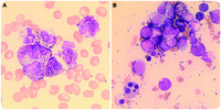 Acute myeloid leukemia with myelodysplasia-related changes demonstrating prominent basophilic differentiation