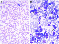 Acquired elliptocytosis in the setting of a refractory anemia with excess blasts and del(20q)