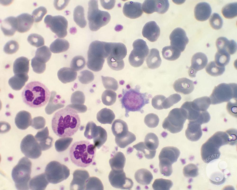 Giant Platelet in a Patient with Thrombocytosis