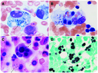 Hemophagocytic lymphohistiocytosis secondary to iatrogenic disseminated histoplasmosis