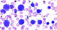 Deformation of erythroblasts in transient erythroblastopenia of childhood caused by HHV-6