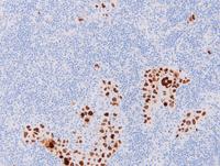 Extracavitary PELHHV8 IHC