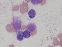 Normal basophil in AML with Inv16