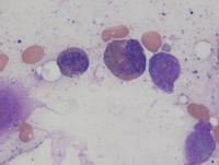 Abnormal eosinophils in inv 16 AML