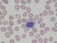 Pseudo Pelger-Huet cells