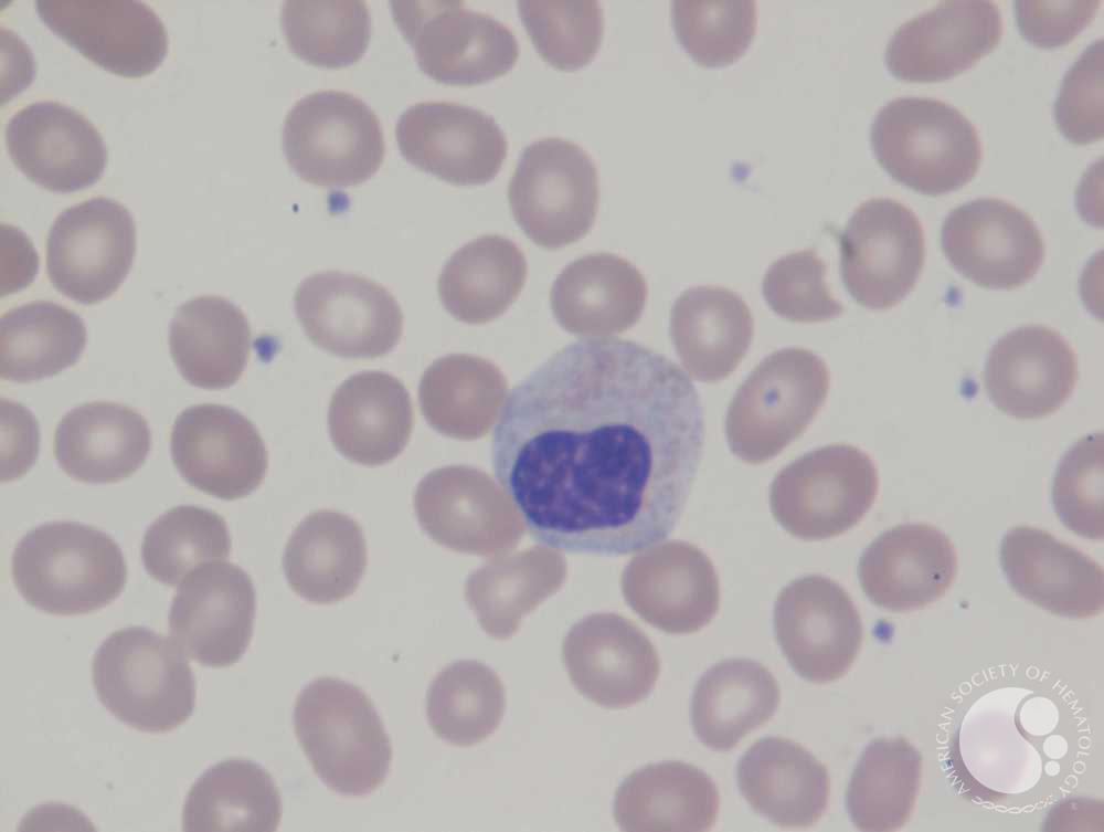 Pseudo Pelger-Huet cells