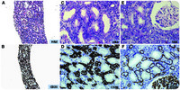 Intravascular large B-cell lymphoma in a kidney biopsy