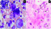 Anaplastic variant of plasma cell myeloma with Dutcher bodies