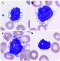 Discrete vacuoles in lymphocytes as a subtle clue to mantle cell lymphoma