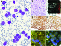 Rhabdomyosarcoma presenting with leukemic phase and massive bone marrow infiltration