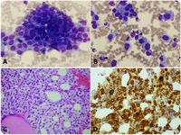 Amelanotic melanoma in the bone marrow