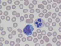 CLL trisomy 12 3