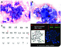 CML with complex chromosome rearrangements and dysplastic megakaryocytes