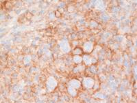GZL-PDL1-IHC