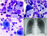 Bone marrow smear examination in the diagnosis of Niemann-Pick B disease