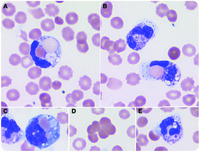 Paroxysmal cold hemoglobinuria with acute renal failure