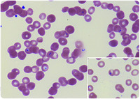 Unexpected babesiosis in a patient with worsening anemia after allogeneic hematopoietic stem cell transplantation