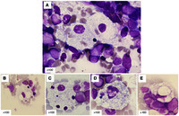 Morphology of Niemann-Pick type C metabolic storage disorder