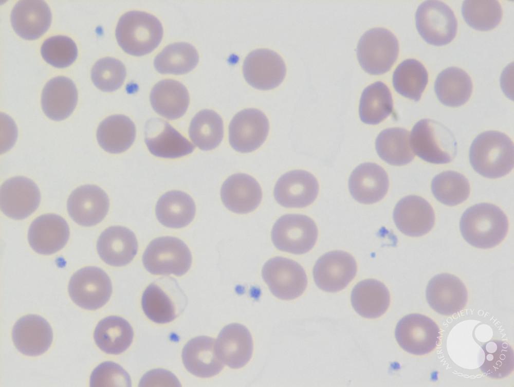 Blister cells 1