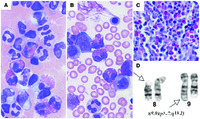 Unusual Infant Eosinophilia Myeloid Neoplasm With Fgfr1 Abnormality 