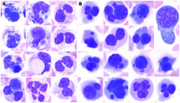 Marked stress dyspoiesis secondary to sepsis and extracorporeal membrane oxygenation