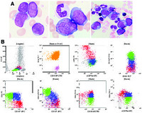 Acute myeloid leukemia with myelodysplasia-related changes demonstrating mixed-lineage phenotype