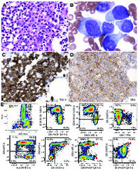 Blastic plasmacytoid dendritic cell neoplasm associated with chronic myelomonocytic leukemia