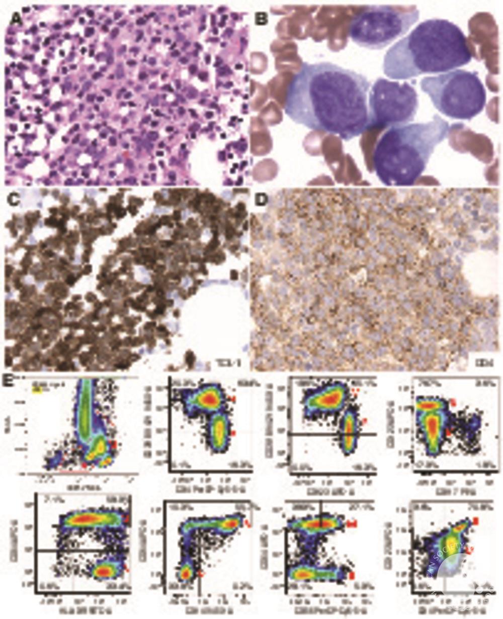 Blastic plasmacytoid dendritic cell neoplasm associated with chronic myelomonocytic leukemia