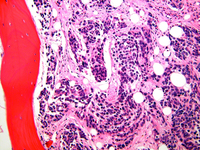 Alveolar rhabdomyosarcoma BMBx 2