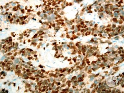 Alveolar rhabdomyosarcoma myogenin nuclear immunoreactivity