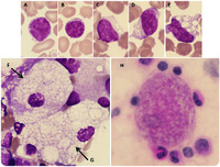 Morphology of Niemann-Pick type C metabolic storage disorder