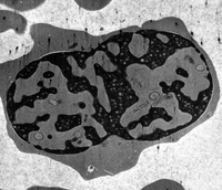 CDA type I EM images unequal nuclear budding and Swiss cheese chromatin